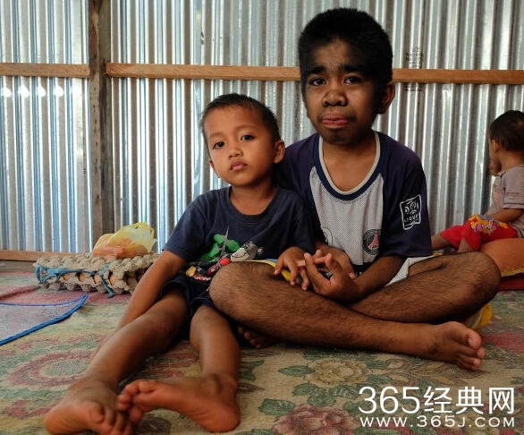印尼13岁男孩返祖全身覆盖黑色毛发 称自己被神选中