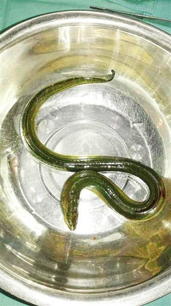 男子腹部剧痛竟从中取出一条黄鳝 医生以为是蛇