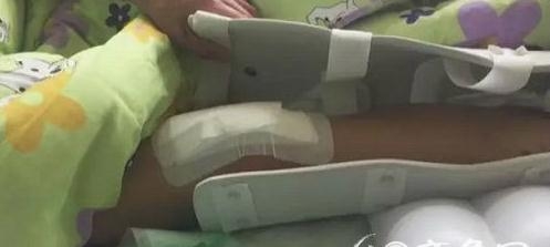 中学生将老师打断腿 膝盖粉碎性骨折