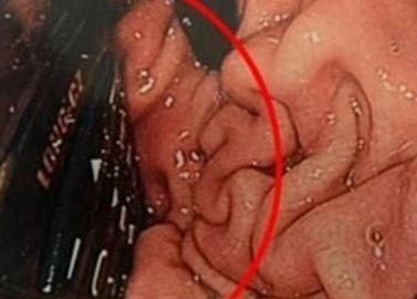 爱尔兰男子吞食整部手机8小时后被取出