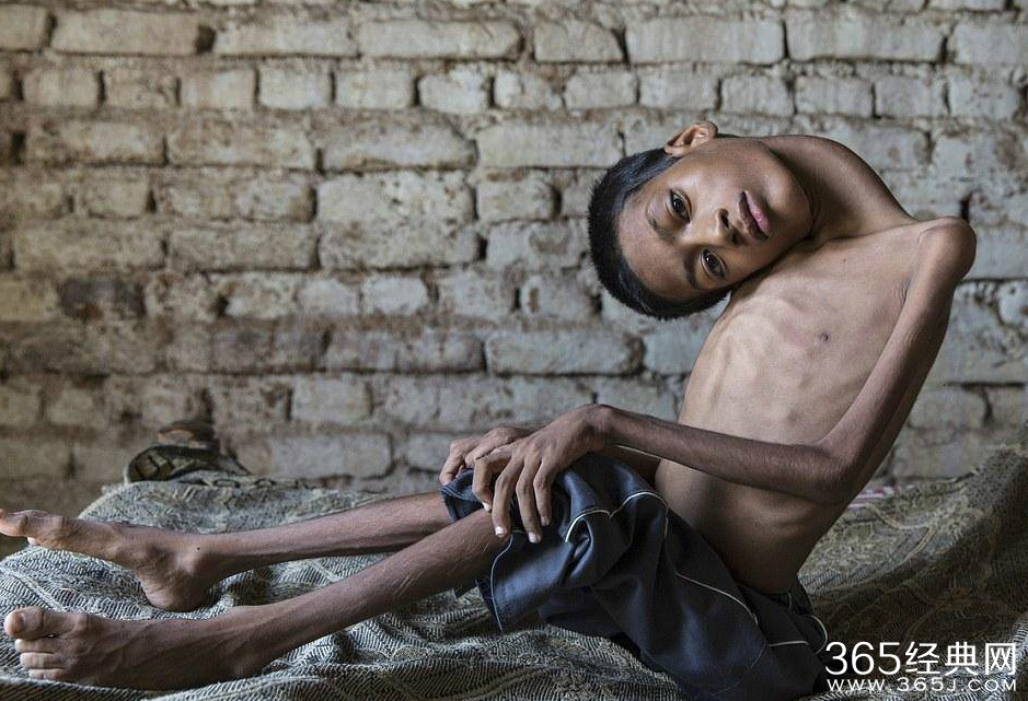 男孩天生头朝下 接受“扶正”手术