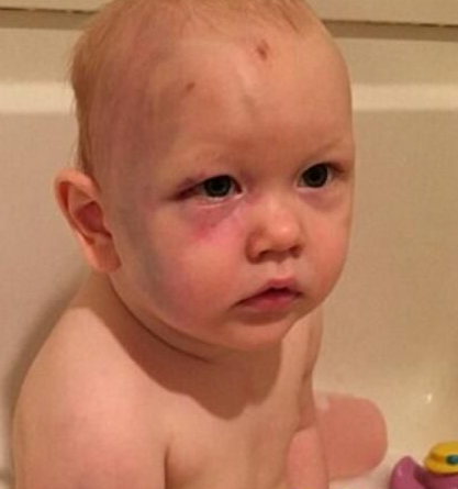 英国黑心保姆照看1岁小孩致其全身淤青