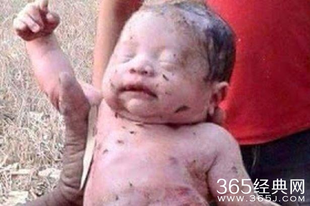 泰国一婴儿被捅14刀后活埋 被救出奇迹生还