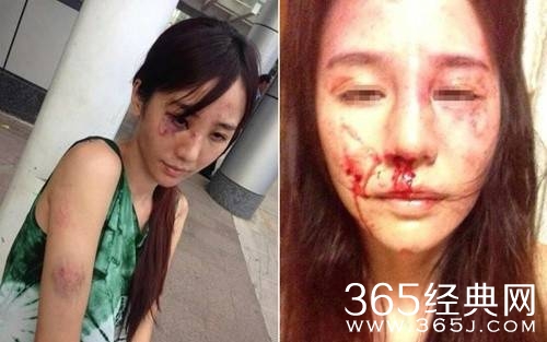 合肥女律师遭丈夫家暴：9根手指筋被砍断