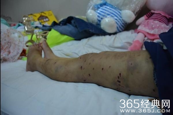 四川十岁女童遭残忍虐待 凶手竟是养母