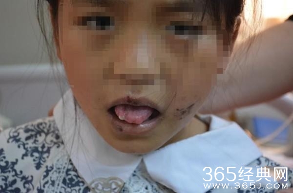 四川十岁女童遭残忍虐待 凶手竟是养母