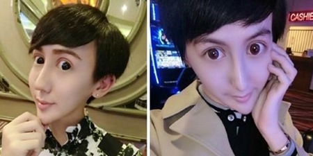 蛇精男打玻尿酸成瘾 1天狂打14针