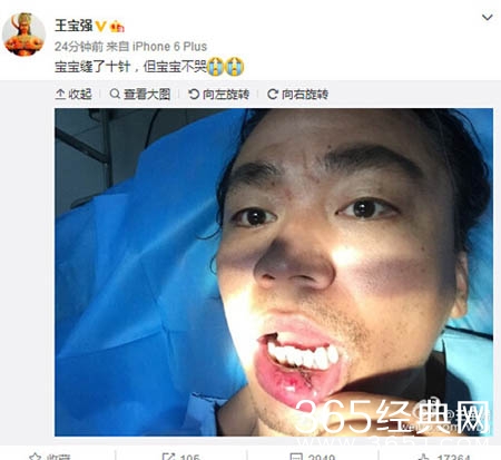 王宝强嘴部受伤缝10针 网友心疼：宝宝不哭