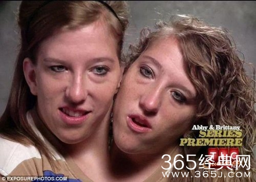 罕见“双头姐妹”共享一个身体 如今已大学毕业