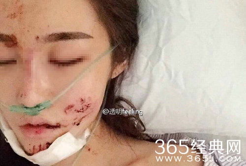 知名网红被毁容 病床憔悴照片曝光