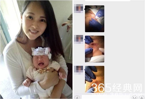 伊能静晒剖腹产伤口照片 反击美医师不认账行为