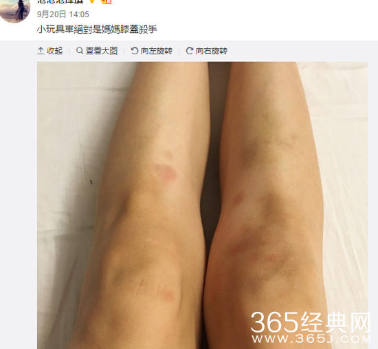 范玮琪双腿现淤青：玩具车是妈妈膝盖的杀手！