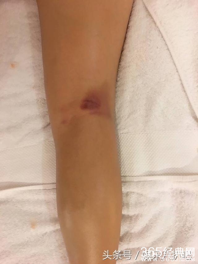 张雨绮晒照片腿部浑身是伤有点心疼，网友:内裤颜色不错