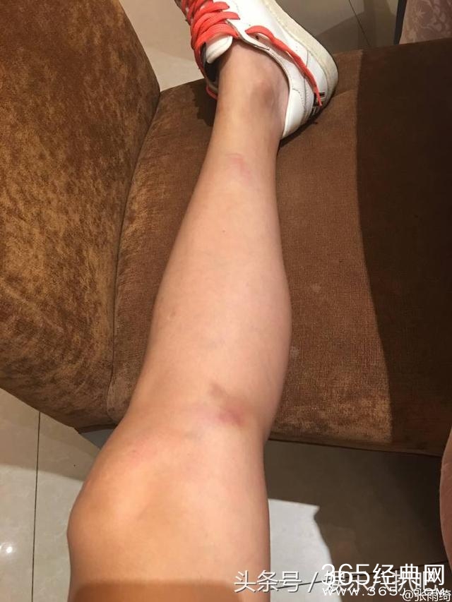张雨绮晒照片腿部浑身是伤有点心疼，网友:内裤颜色不错