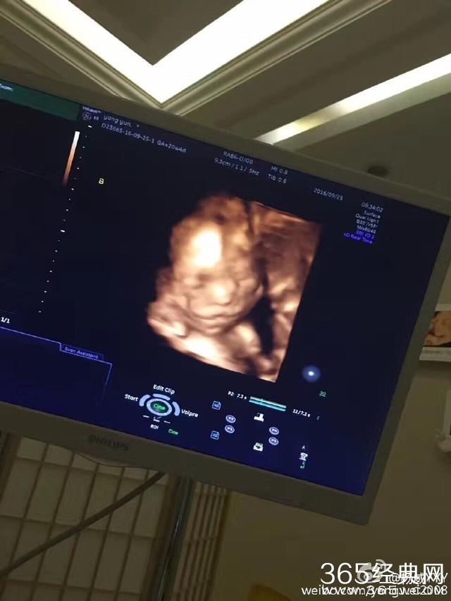 恭喜！杨威晒杨云腹中胎儿B超照，证实老婆所怀的为龙凤胎