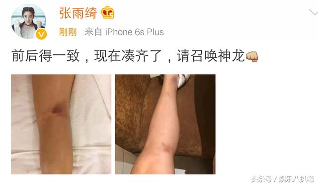 张雨绮晒照片腿部浑身是伤有点心疼，网友:内裤颜色不错