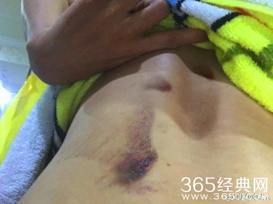 G姓女演员坠崖真相大白，当事人郭柯彤：没那么严重