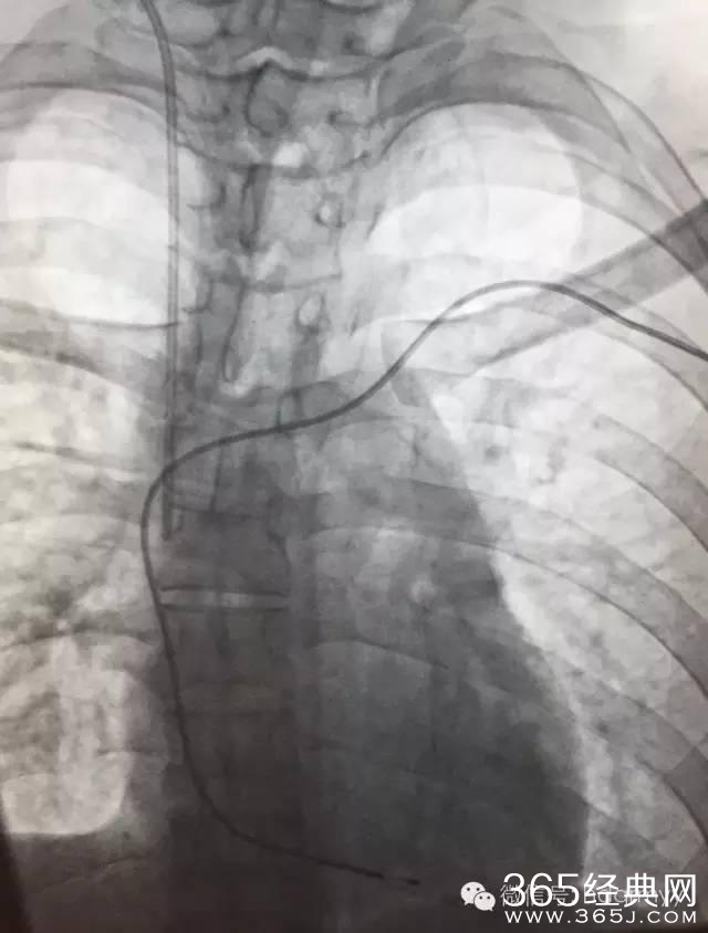 广州男子感冒没在意,几天后心跳停搏差点送了命!这种病入秋更需警惕