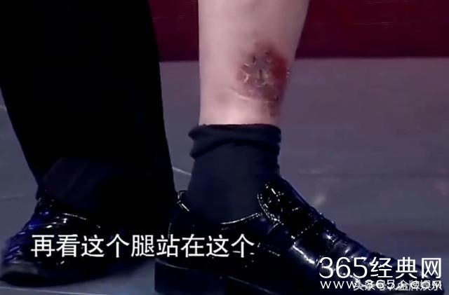 朱之文演出活动太繁忙，造成腿部严重静脉曲张