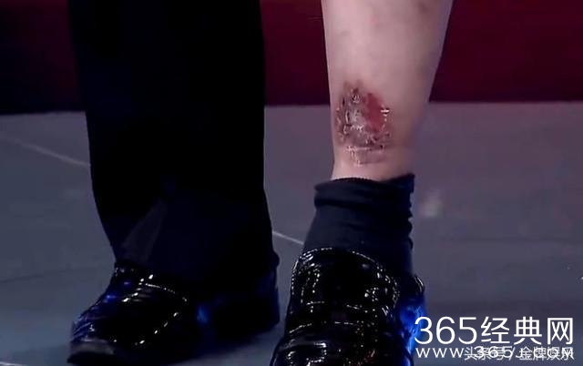 朱之文演出活动太繁忙，造成腿部严重静脉曲张