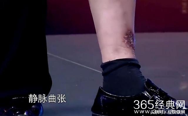 朱之文演出活动太繁忙，造成腿部严重静脉曲张