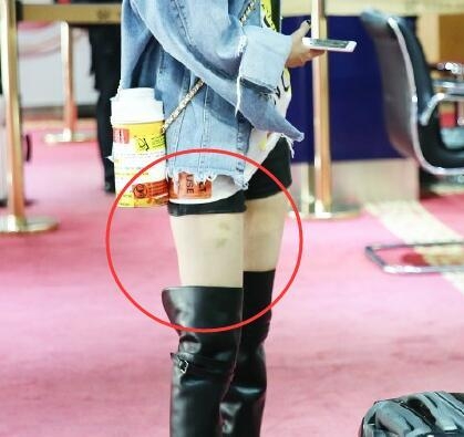 杨幂最新机场照，满屏幕都是腿，腿上淤青分外显眼！