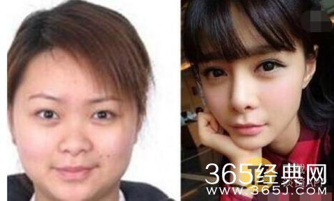 妈呀！沈梦辰下巴里的白色异物是什么，难道是假体？！