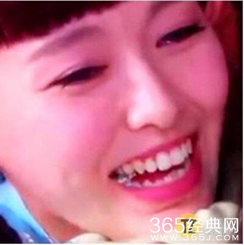 妈呀！沈梦辰下巴里的白色异物是什么，难道是假体？！