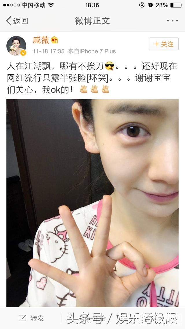 戚薇拍摄影片只是面部受伤这么简单？