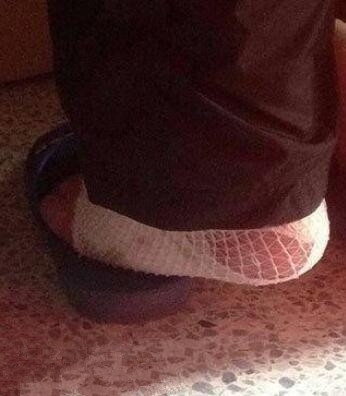 大学生抖腿抖到骨折是怎么回事 抖腿有什么坏处