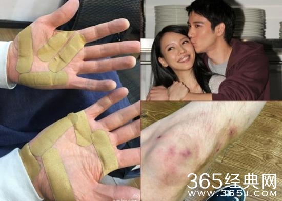 王力宏受伤受伤是怎么回事 王力宏为什么会受伤