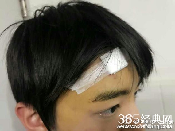 王俊凯脸部受伤是怎么回事 王俊凯脸部为什么会受伤