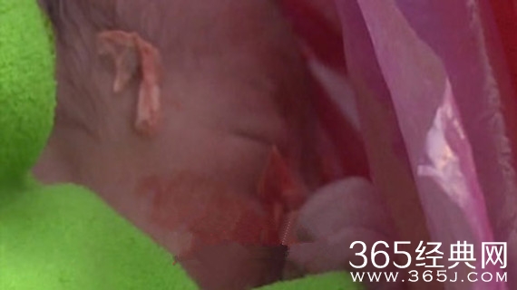 女婴出生两小时被套塑料袋遗弃