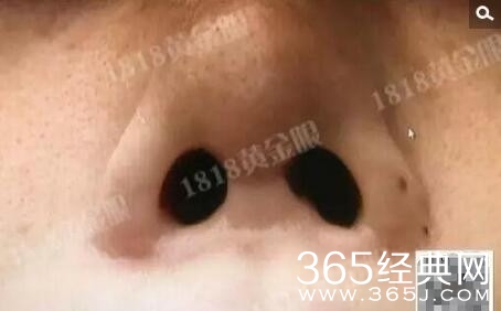 女子整容鼻孔变成猪八戒图片 小孙整容前后照片