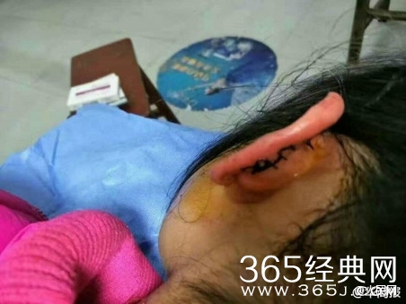 陕西一小学生未完成作业 遭班主任撕裂耳朵