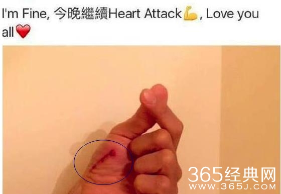 林峰被曝演唱会意外受伤满手鲜血 林峰演唱会意外受伤严重吗