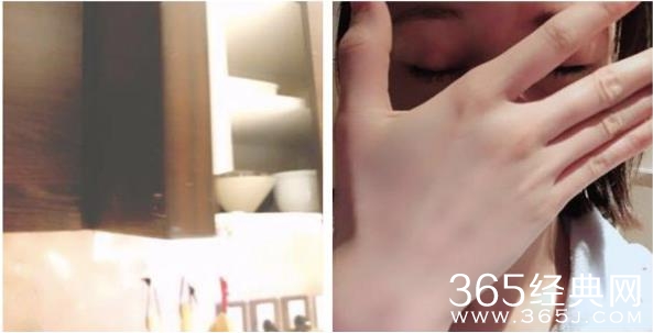 郑爽自曝眼眶被撞肿 郑爽为什么会受伤