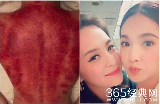 阿娇深夜晒血淋淋后背照 后背像被撕掉一层皮是怎么回事