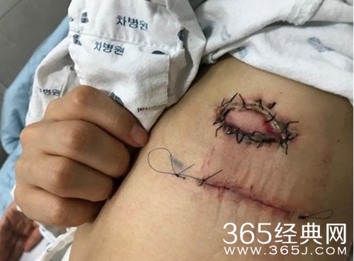 韩艺瑟遇医疗事故，伤口愈加严重