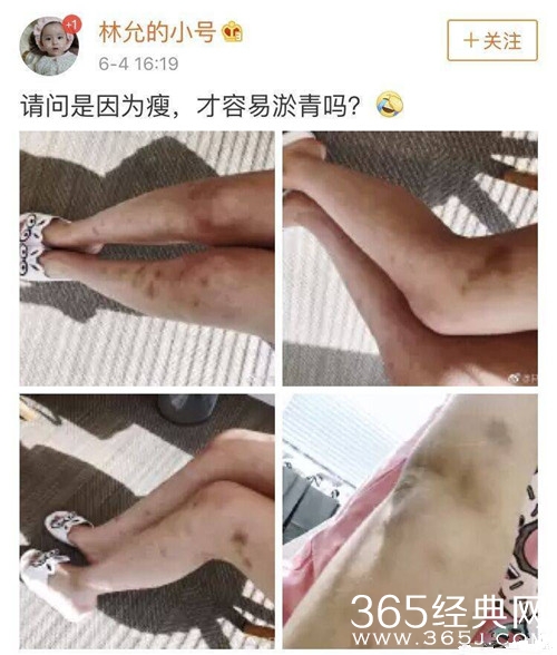 林允晒照双腿淤青，惨不忍睹