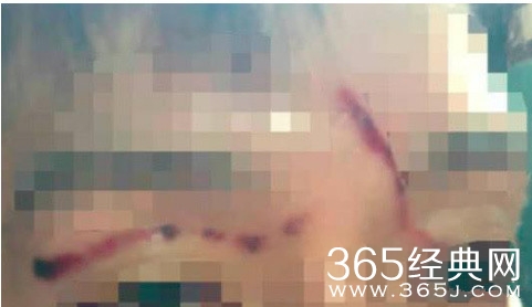 具荷拉被男友暴打导致子宫出血 全身淤青 十分可怕