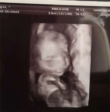 凌潇肃晒妻子B超照 竟是今年9月拍的 预产期快到了