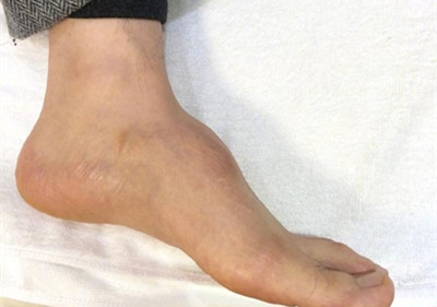 黄晓明回应垫鞋垫 称左脚脚背本来就比较高