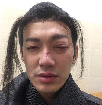 威廉拍戏出意外 眼睛意外被打伤 着实让人心疼