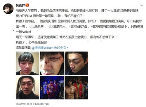 威廉拍戏出意外 眼睛意外被打伤 着实让人心疼