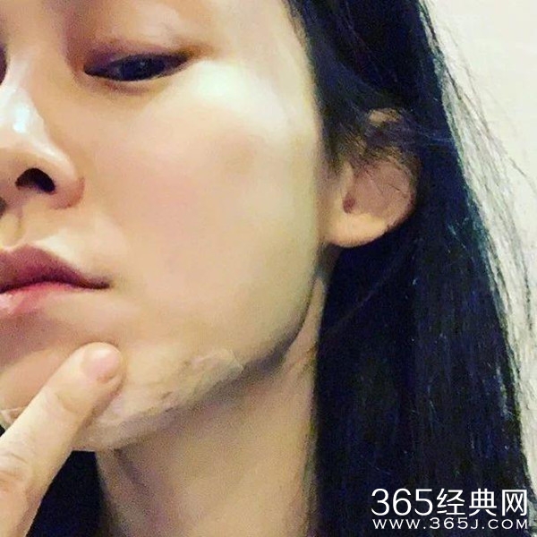 范玮琪摔倒下巴血肉外翻缝了15针 却成催生现场？