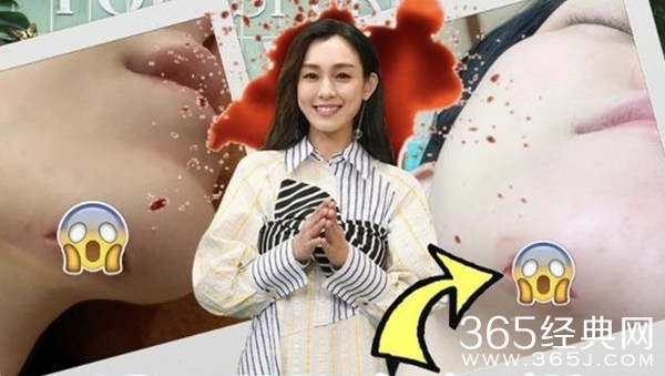 范玮琪摔倒下巴血肉外翻缝了15针 却成催生现场？