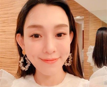 范玮琪又摔倒了 晒照下巴缝15针照片