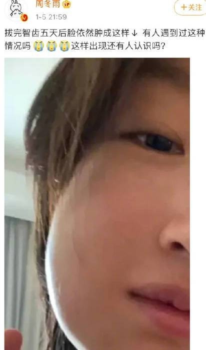 周冬雨戴口罩领奖 拔完智齿脸肿7天