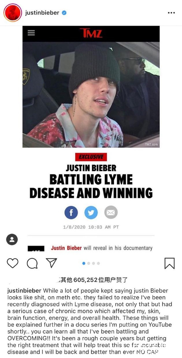 比伯发文承认患上莱姆病 治疗过程艰难